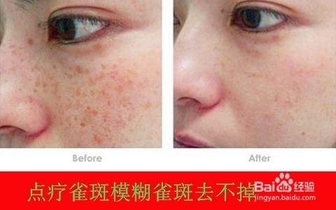 男生如何治疗满脸雀斑
