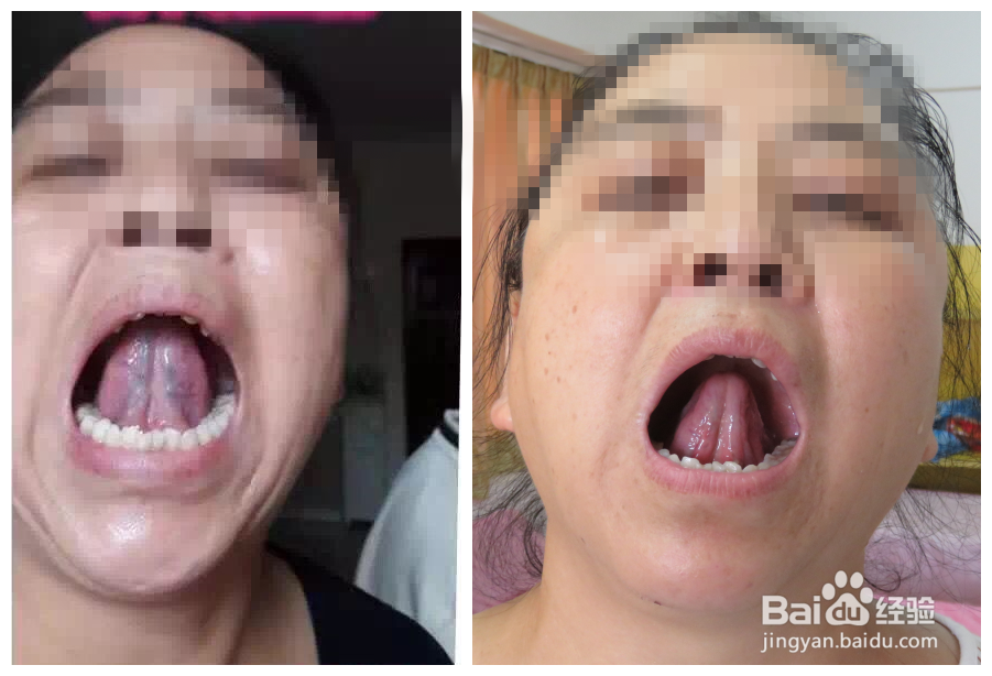 刺血的理论依据及基本原则