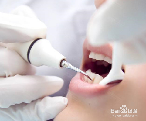 洗牙后如何养护呢?