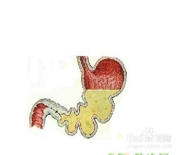 十二指肠溃疡四大危害