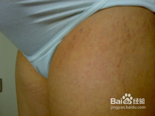 怎样去除产后妊娠纹