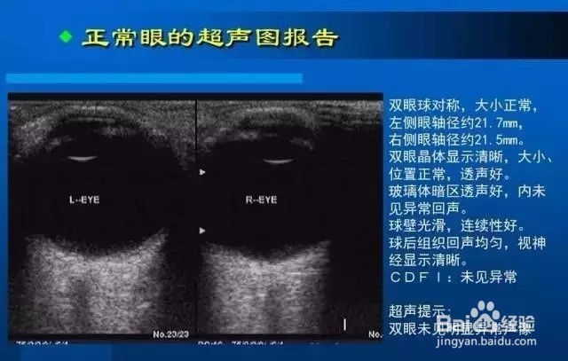 几种常见眼病B超图谱及诊断