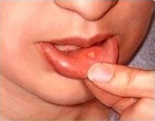 经常口腔溃疡怎么办?