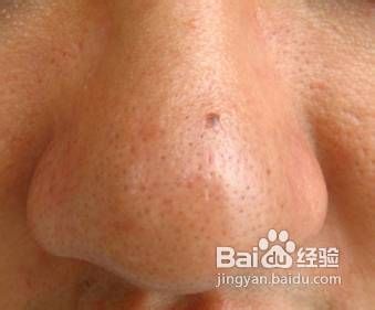 怎么彻底去黑头