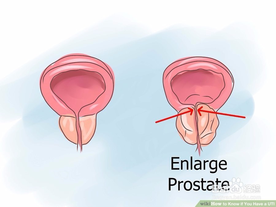 如何知道你是否有UTI
