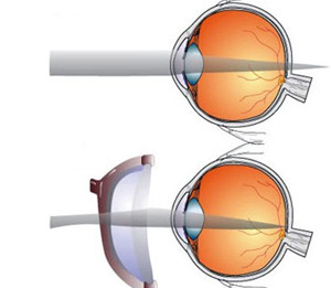 远视眼治疗方法有哪些?