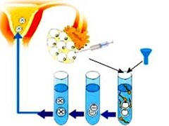 试管婴儿成功经验分享