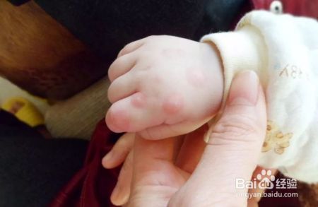北京今年将是手足口病“高峰年”？高发期宝妈们该如何做好预防？