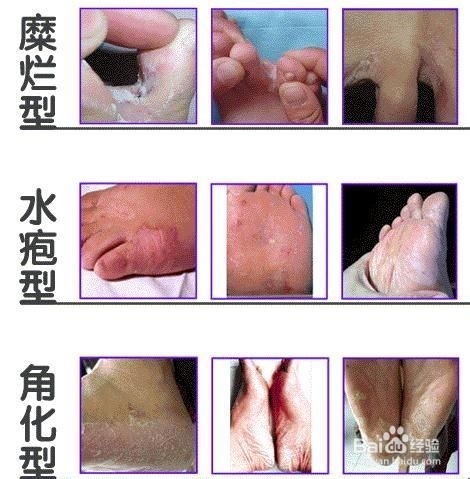 有了脚气怎么治