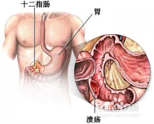 如何根据症状辨胃病
