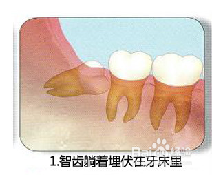 长智齿需要拔掉,医生究竟是怎样拔智齿的呢