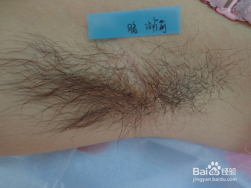 怎样处理腋下脱毛后的毛孔粗大