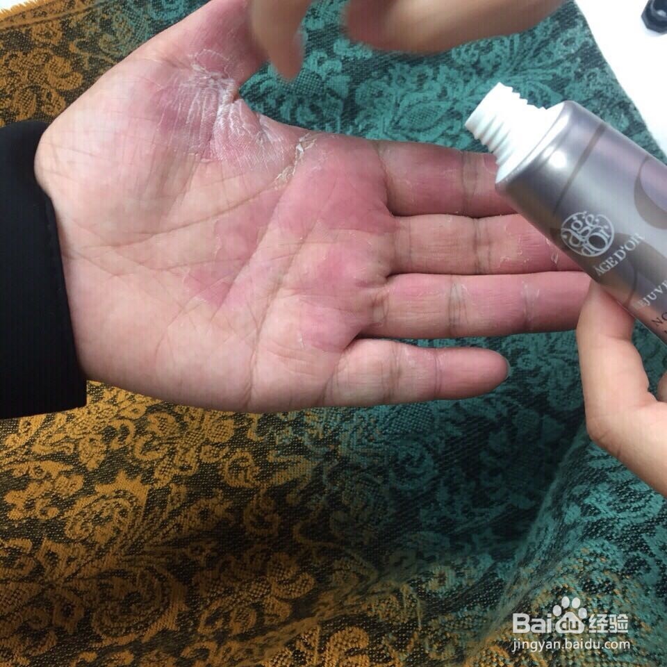 洗洁精损伤皮肤的救助