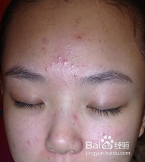 血热的表现及调养