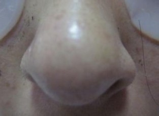 怎样清除角质和黑头