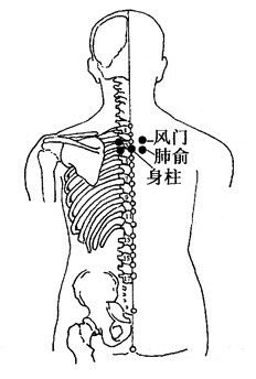 百病拔罐：[11]咳嗽的拔罐疗法