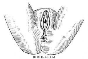 褥疮长窦道怎么办