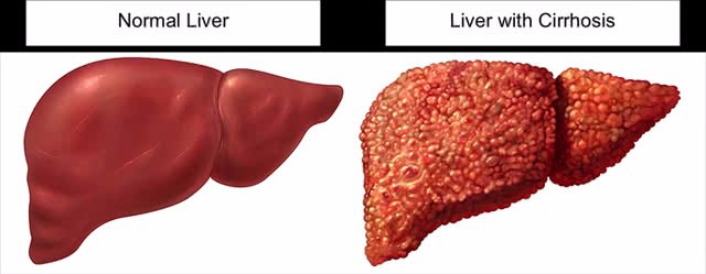 长白山药谷丁香红茶和肝硬化的关系
