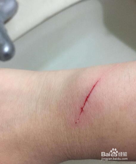 被猫抓伤怎么办