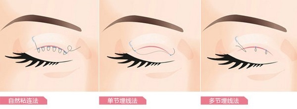 埋线双眼皮做完之后出现的肿胀感如何缓解
