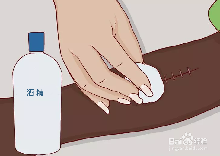 用医用钉皮机进行伤口闭合后,怎么拆钉