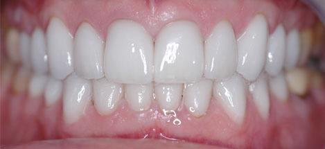 牙齿贴面美白全攻略