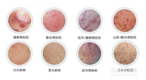 青春痘的日常治疗