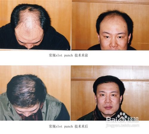 脱发治疗最快的方法