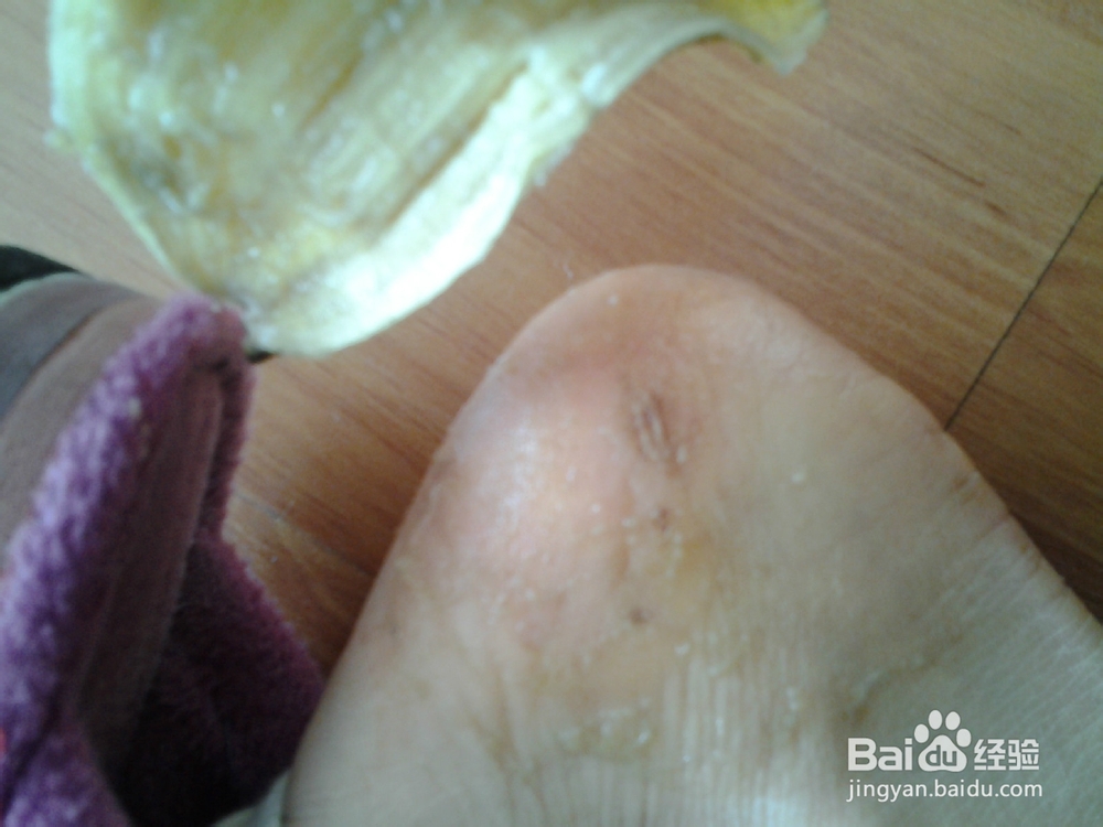 香蕉皮巧治皲裂