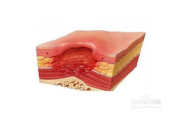 褥疮伤口不同颜色处理方法