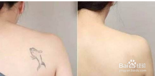 当兵体检手上有纹身怎么办