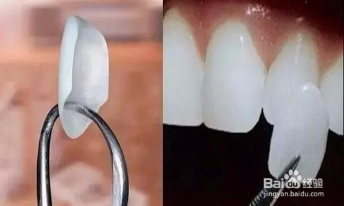 贴面美白牙齿