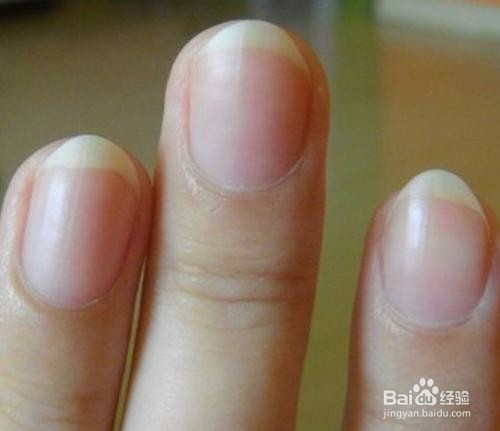 手指甲有点泛白是什么原因