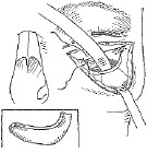 眼眶骨折的危害