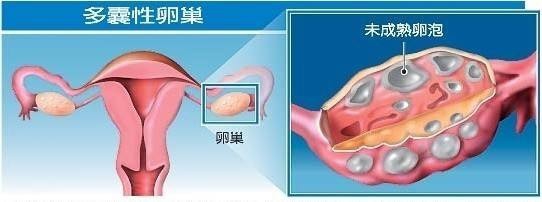 多囊卵巢综合征有哪些症状 多囊怎么调理