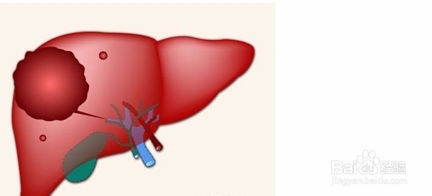脂肪肝及常见的肝病预防