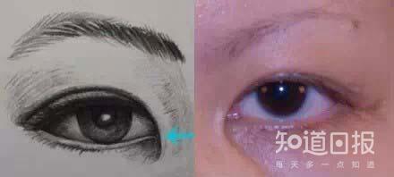 开眼角手术后留下明显疤痕，该怎么办