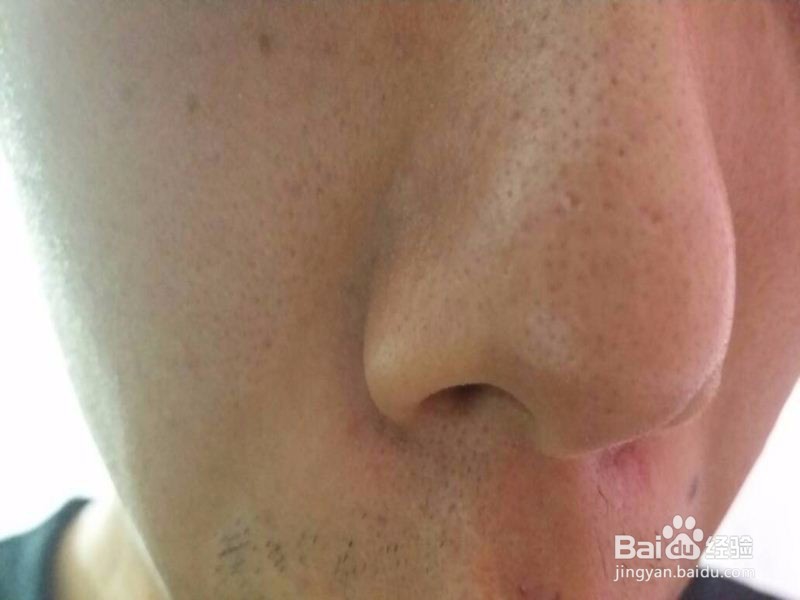 黑头的原因及护理方法