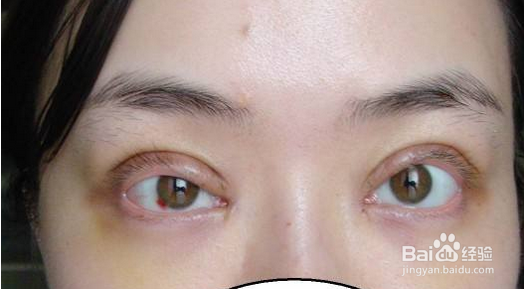 如何把双眼皮做得自然不露痕迹