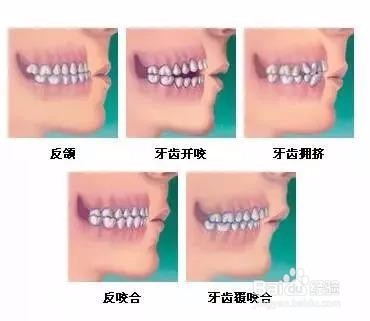 这些不良习惯可能导致儿牙畸形,家长要注意!
