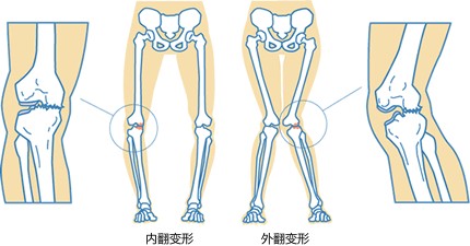 “童车病”怎样形成的,怎样选儿童自行车