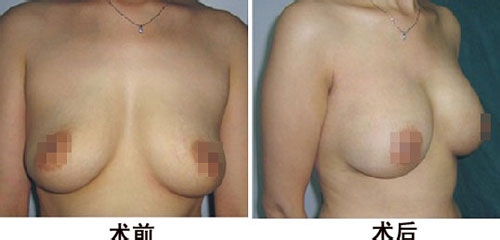 乳房下垂矫正
