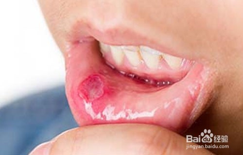 我来告诉你为什么你的口腔总是溃疡？