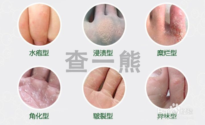 孙叔公灰指甲治疗手册