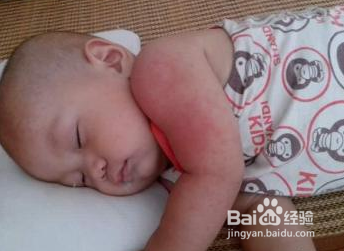 夏季长痱子,要如何护理?