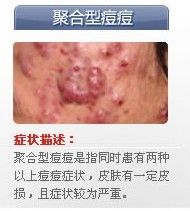 痘痘的种类有哪些