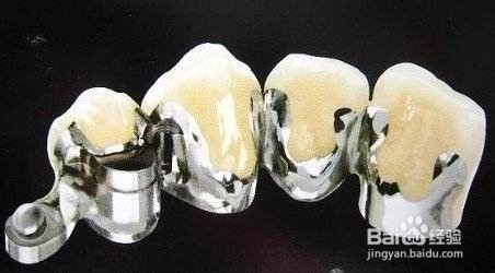 哪种烤瓷牙性价比高