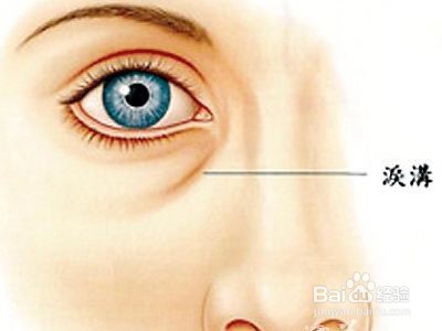 眼袋怎样去除好