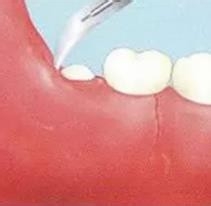 拔智齿过程是怎么样的？