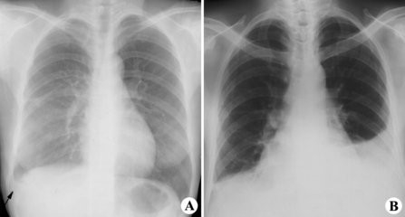 胸膜炎与脓胸有哪些症状？